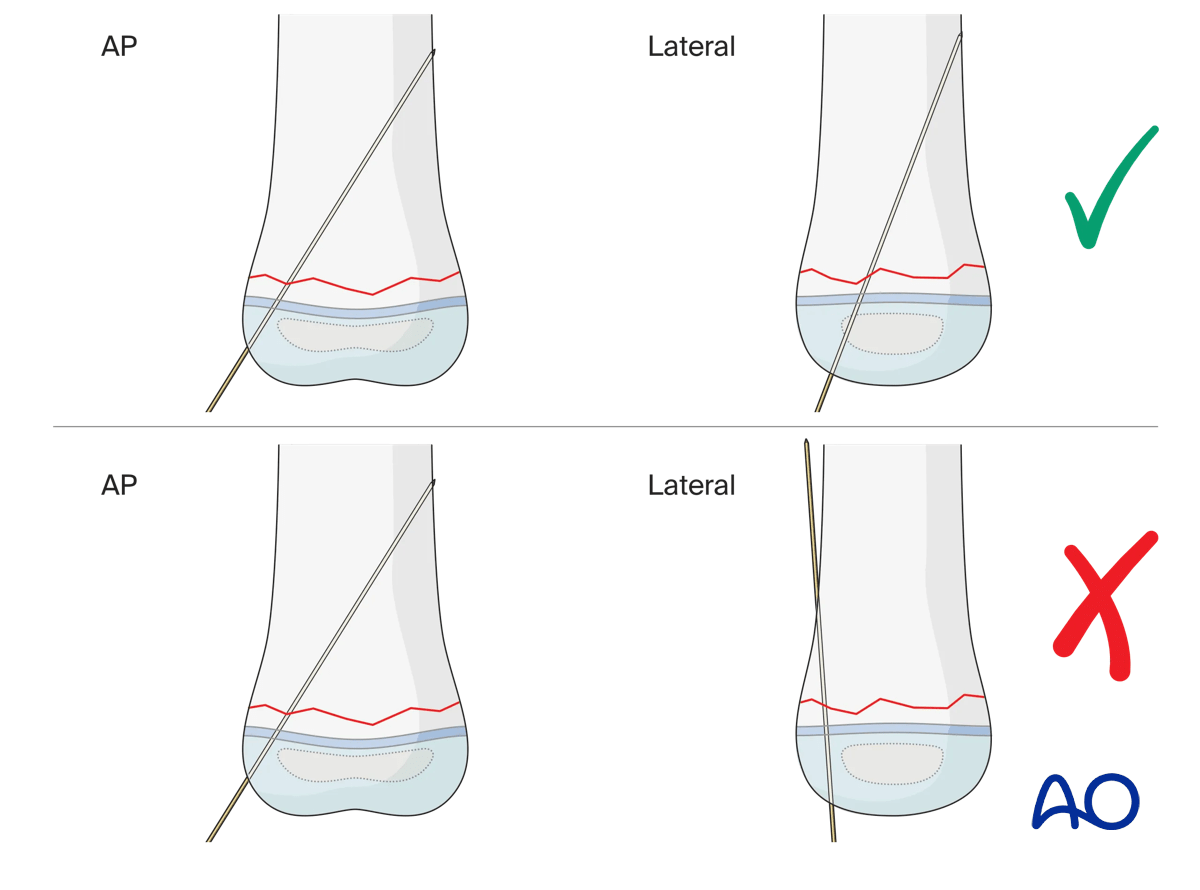 Bony resistance throughout K-wire insertion