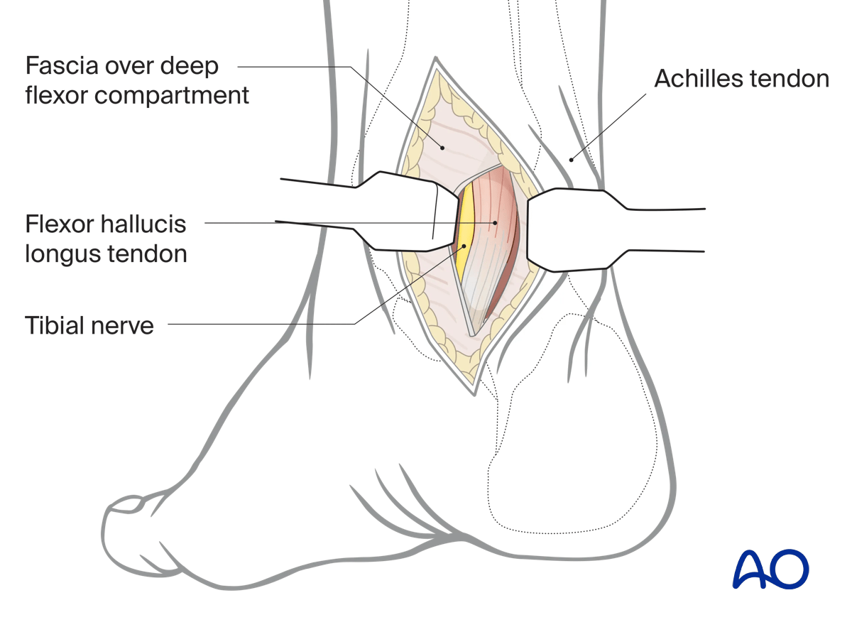 Posteromedial talus approach identify FHL tendon; dissect posteriorly and laterally, staying medial to Achilles