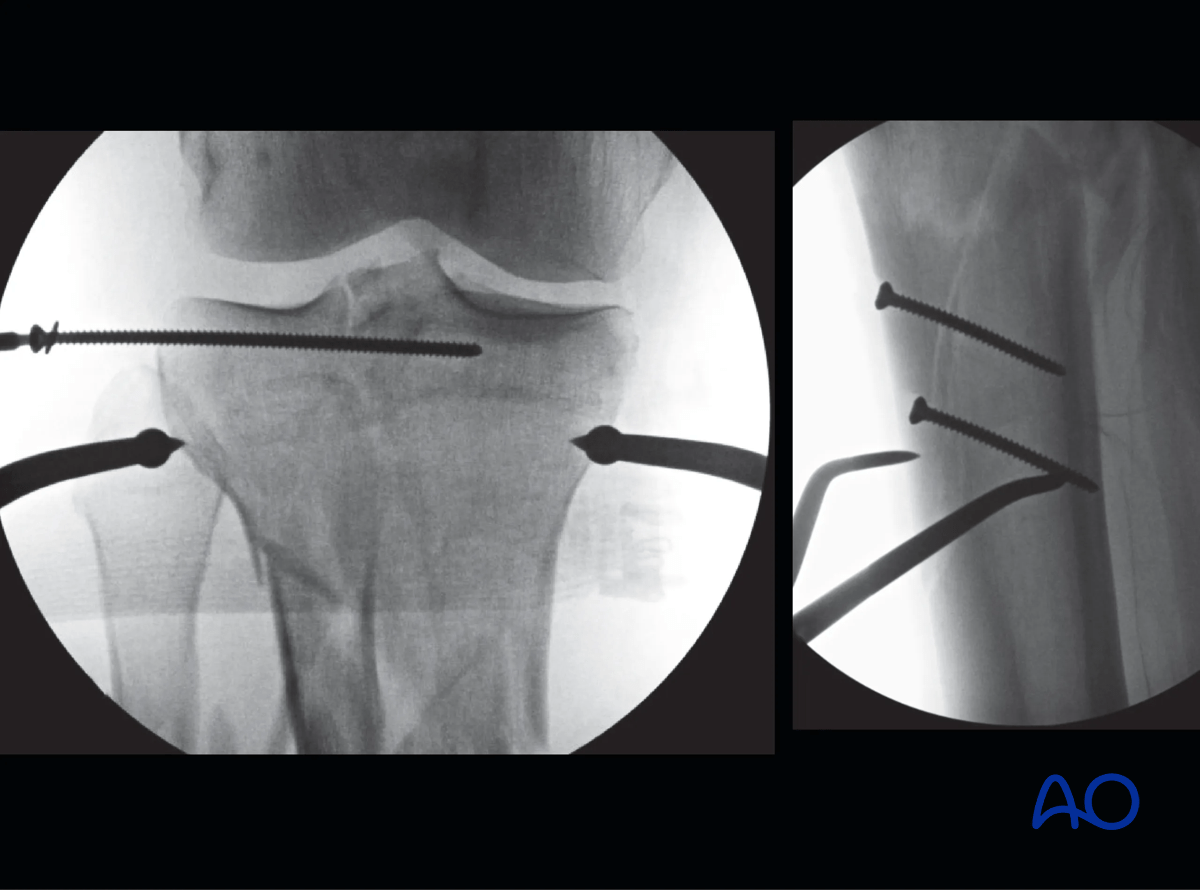 Proximal tibia fracture – ring fixation: reduction of articular surface