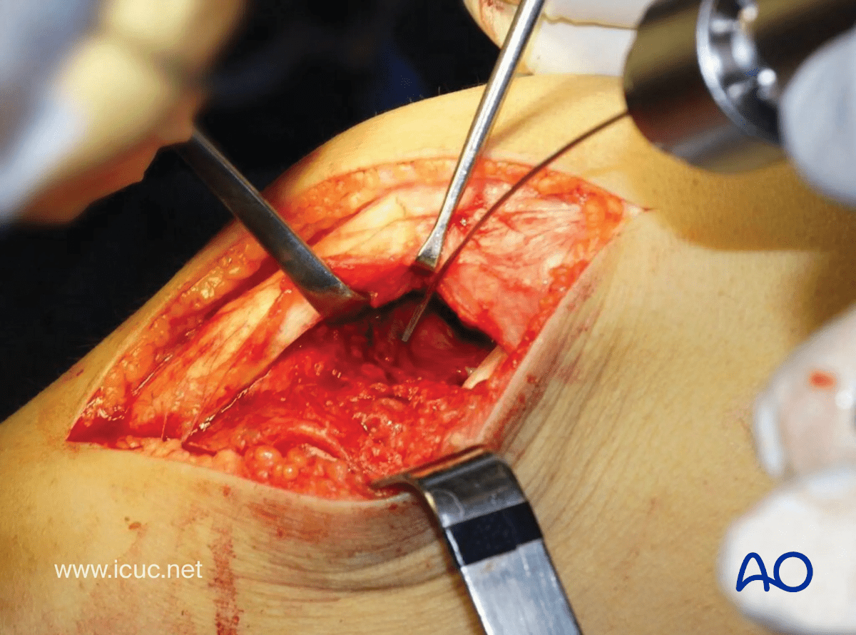 Avulsion of tibial spine – tibial spine has been reduced and held with a K-wire