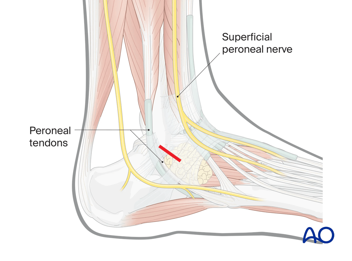 Direct lateral talus approach longitudinal incision parallel to tendons; lateral fluoroscopy guides precise placement