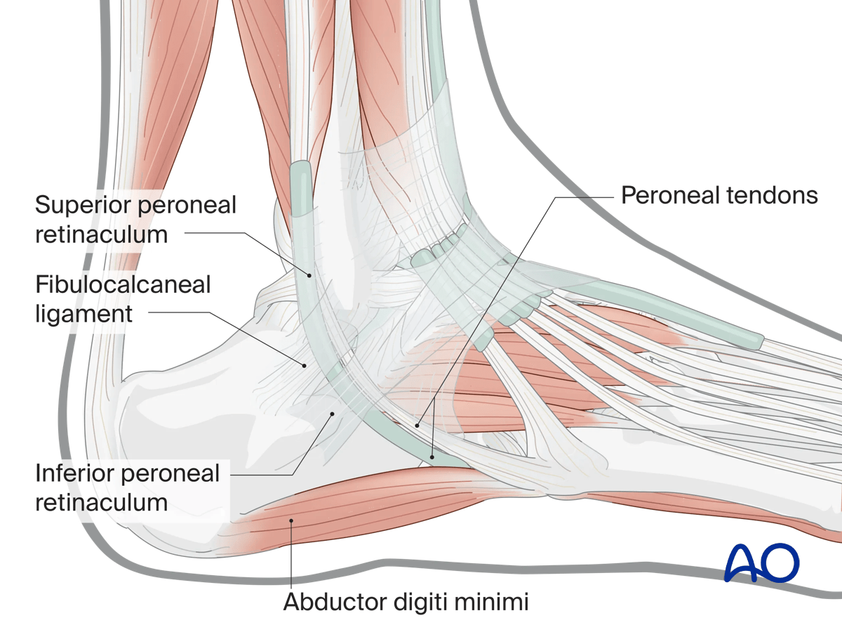 Extended lateral approach to the calcaneus: subperiosteal flap elevates lateral ligament and peroneal retinaculum