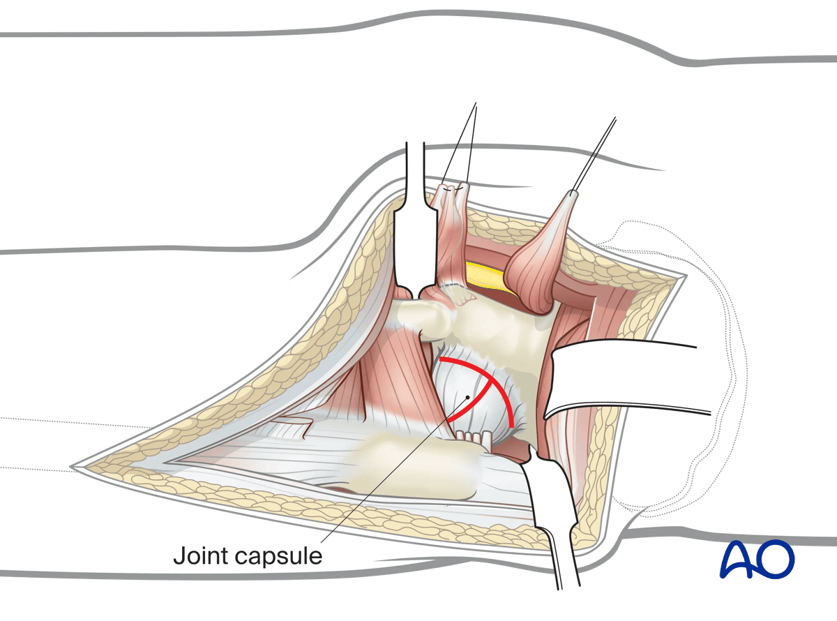 Illustration of Kocher-Langenbeck approach: T-shaped capsulotomy for joint inspection, avoiding limbus damage.
