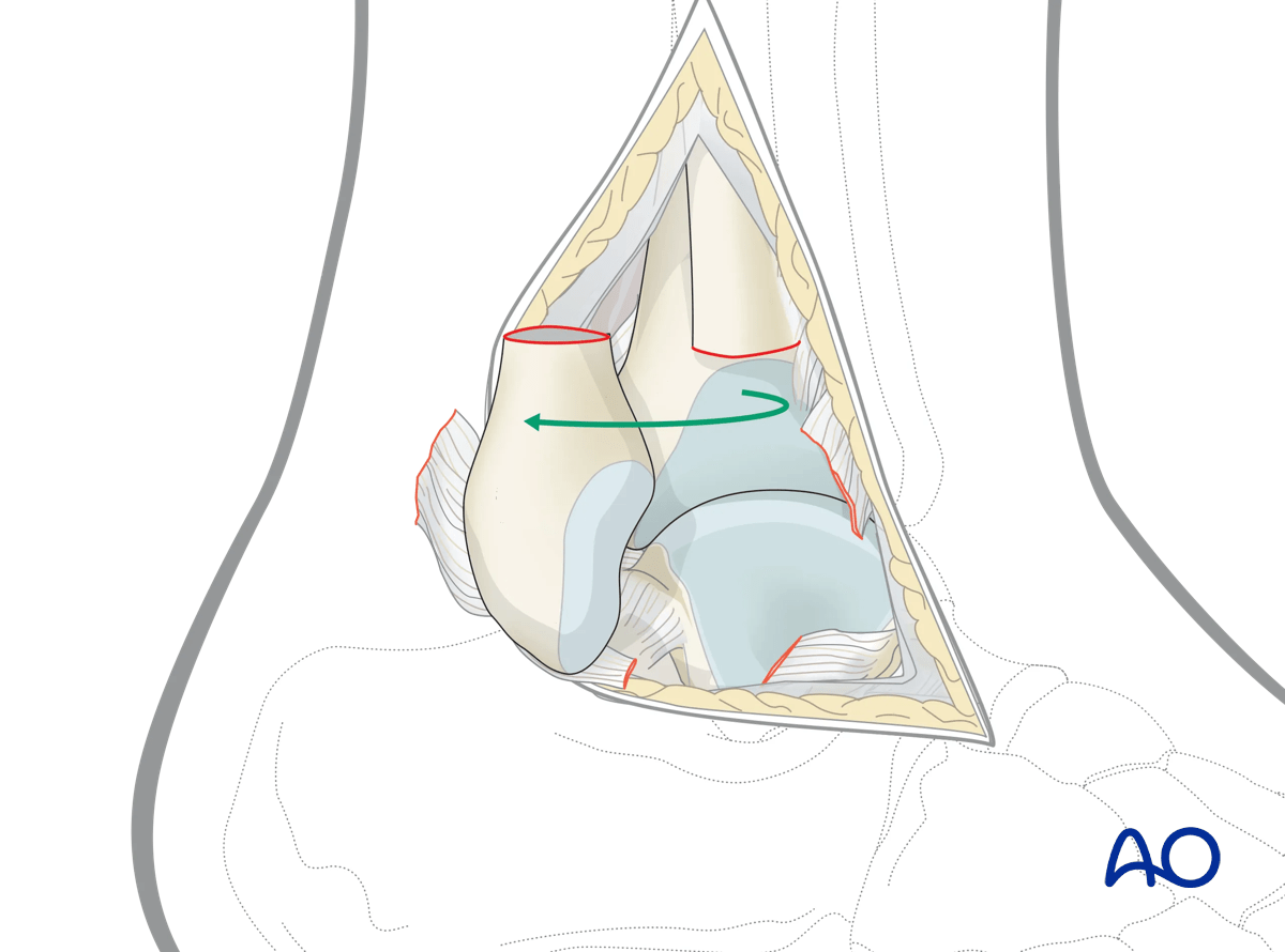 Lateral malleolar osteotomy reflects bone to improve access and visualization of hard-to-reach anatomy
