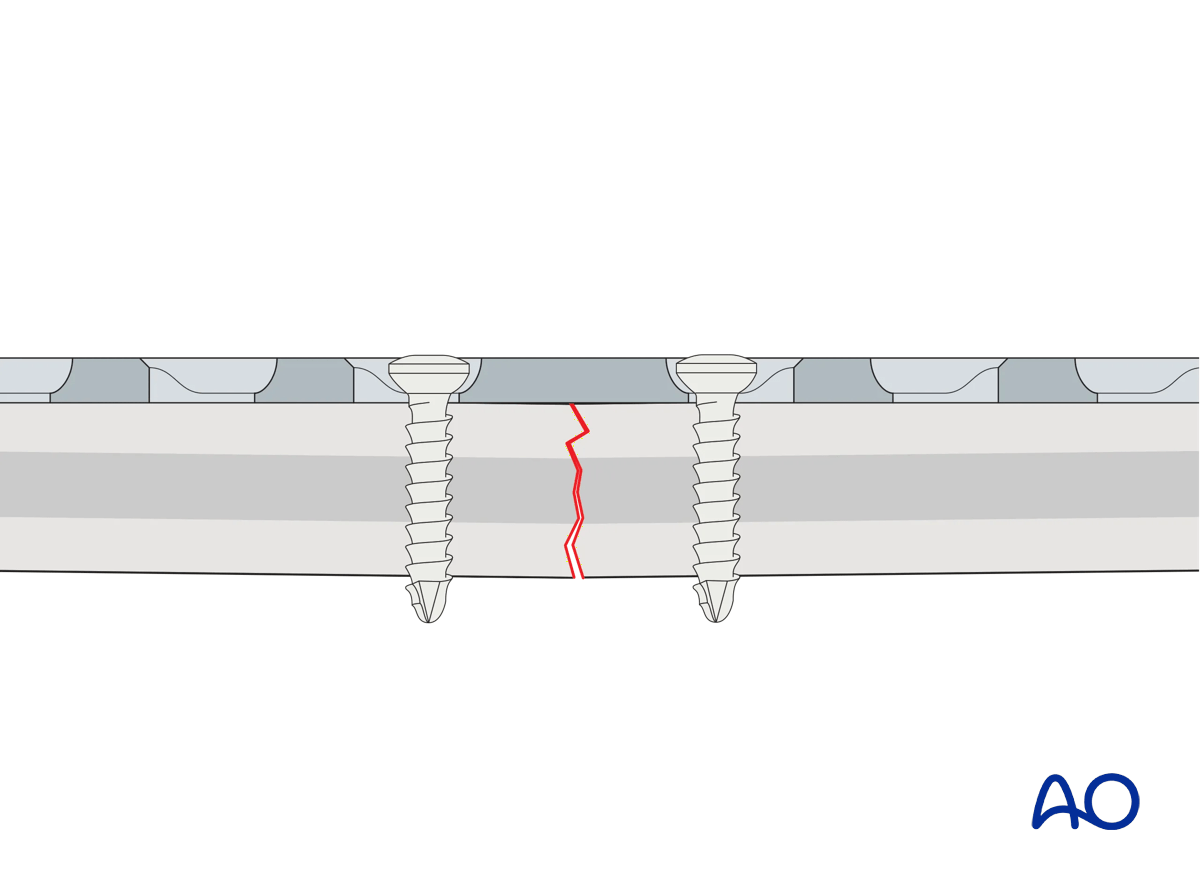 Illustration showing gapping of the far cortex when a precisely contoured plate is tensioned by tightening the load screw.