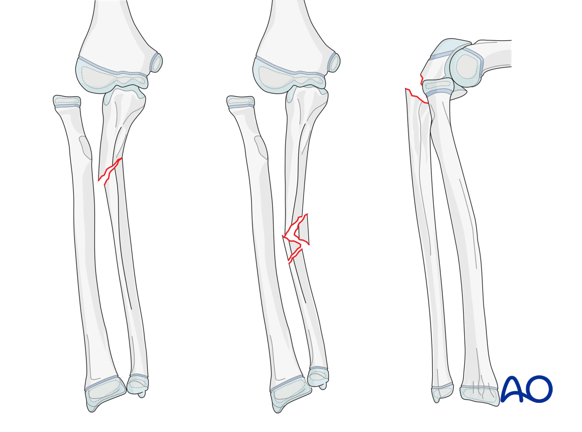 Monteggia lesion in a pediatric patient with lateral and posterior dislocation of the radial head