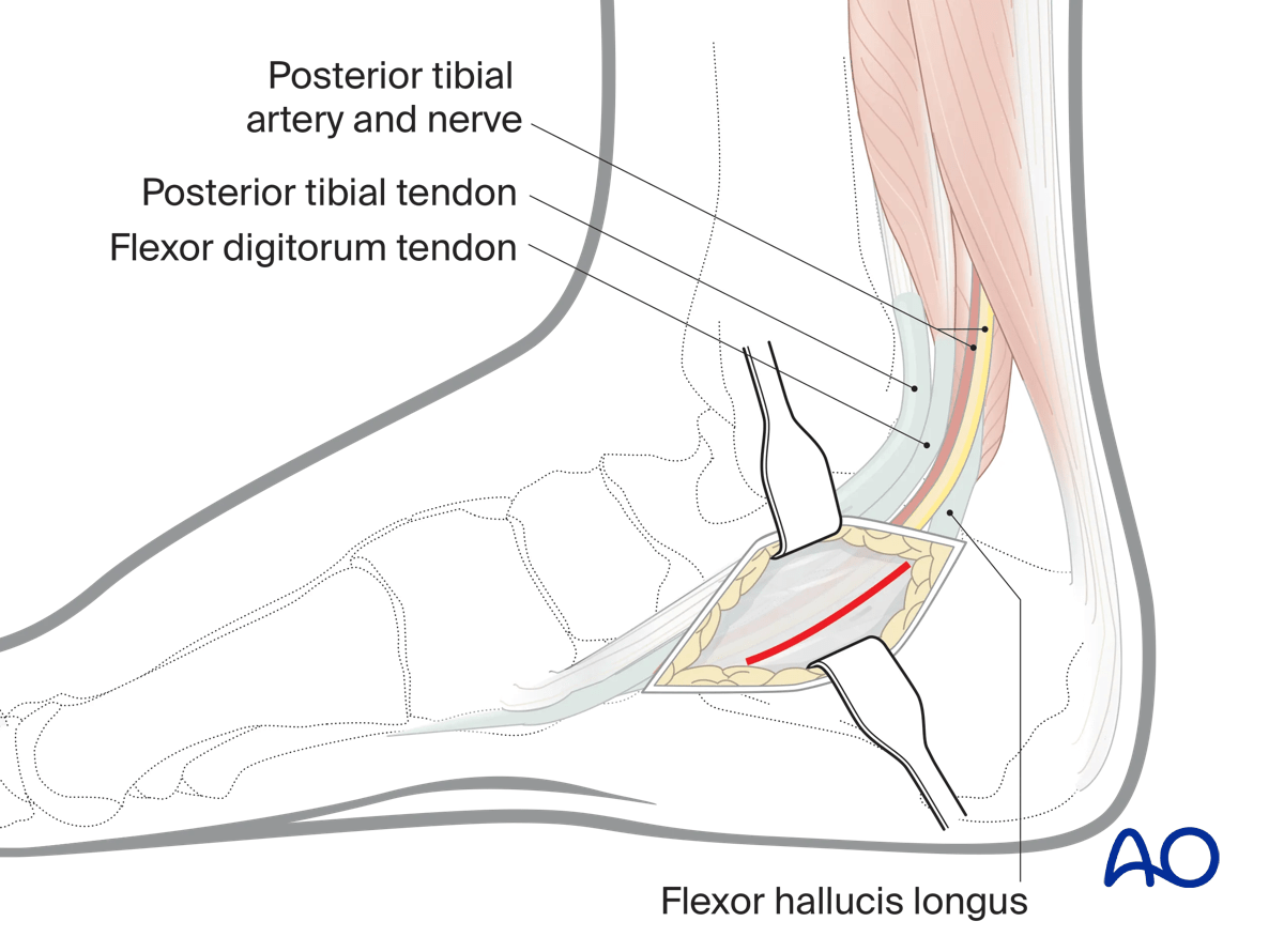 Neurovascular bundle and tendons in medial approach to the calcaneus