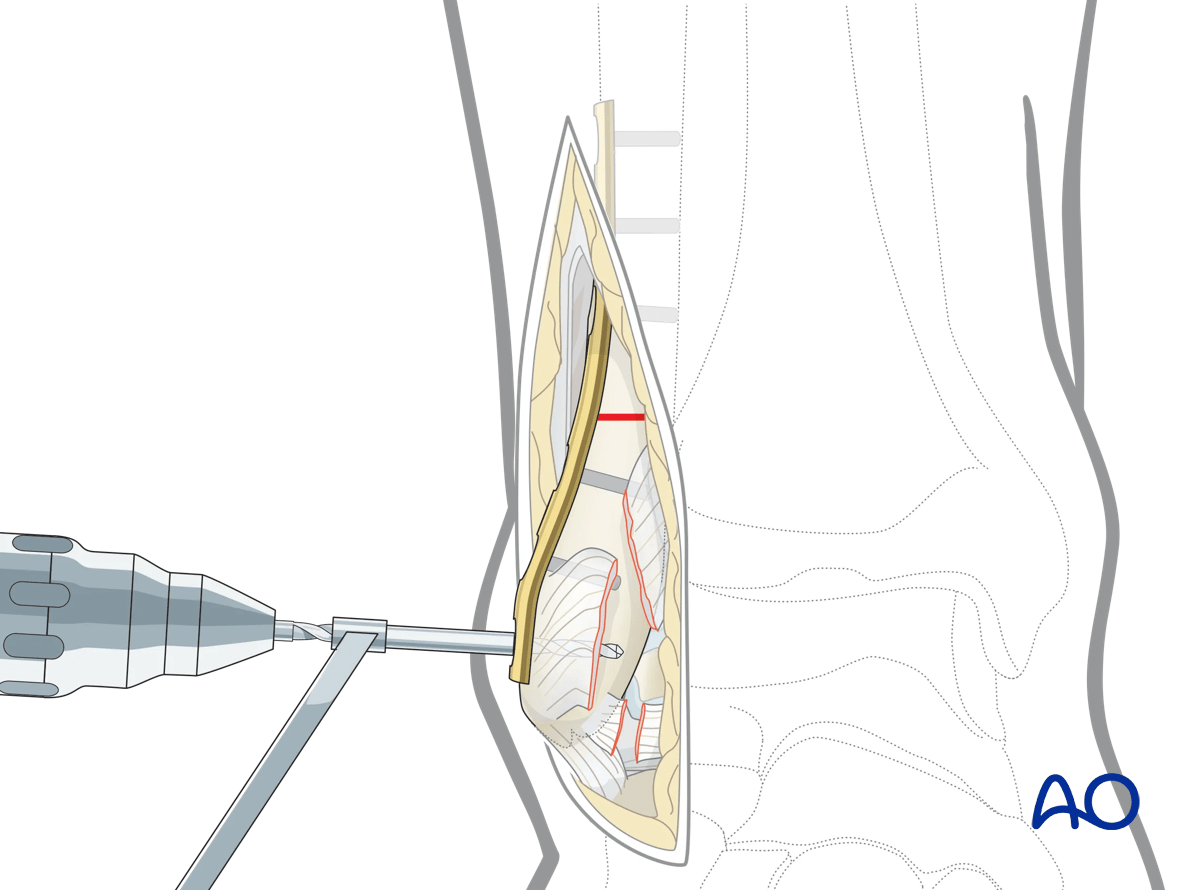 Lateral malleolar osteotomy predrill fibular plate holes; avoid proximal screws blocking osteotomy compression
