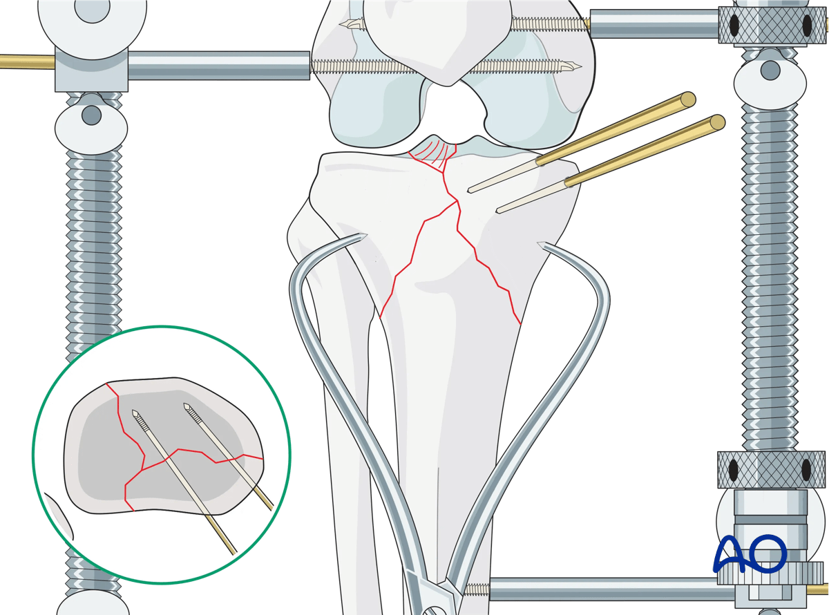 Proximal tibia - Complete articular fracture with fragmentary medial plateau: preliminary reduction