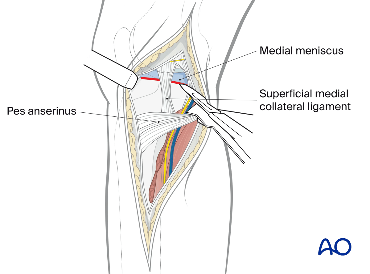 Medial/posteromedial approach to the proximal tibia, exposure