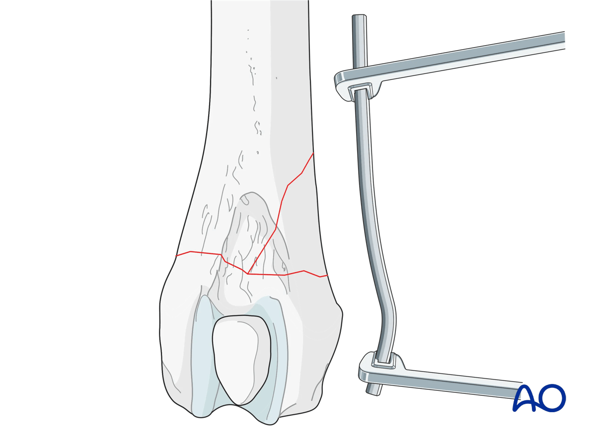 Plate contouring for plate application to the dog distal femur