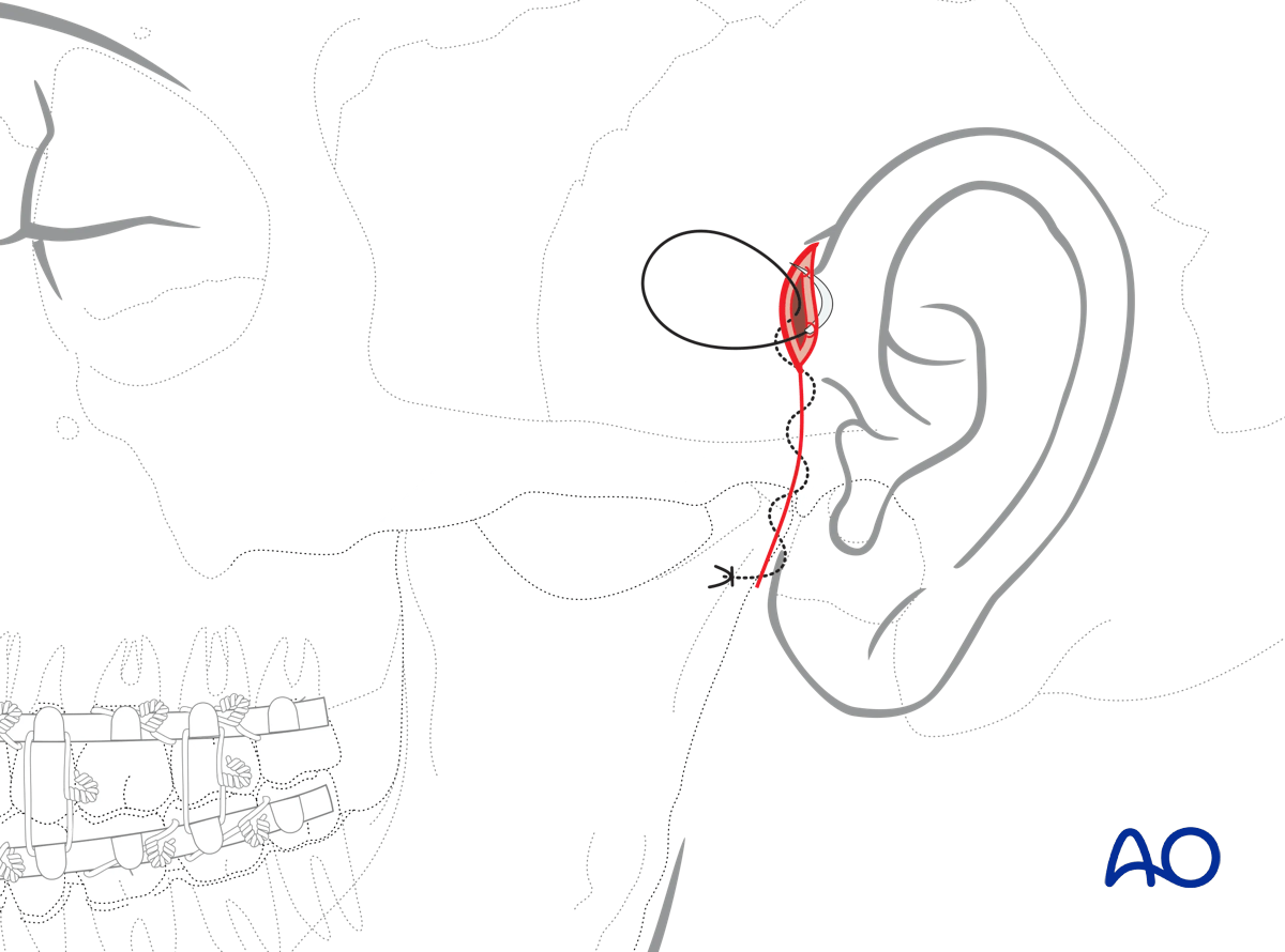 Endaural approach to condyle: wound closure