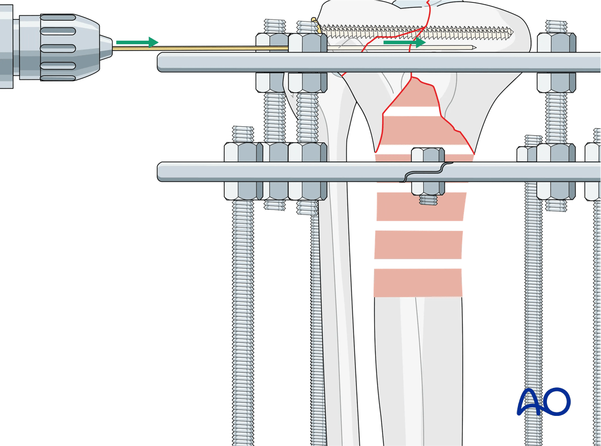 Proximal tibia fracture – ring fixation: fracture fixation