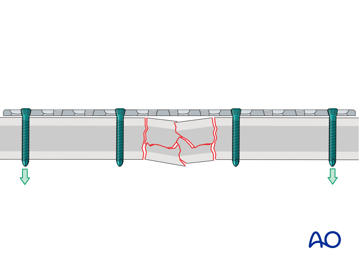 Illustration showing bridge plating for multifragmentary long bone fractures, providing stability and promoting callus formation.