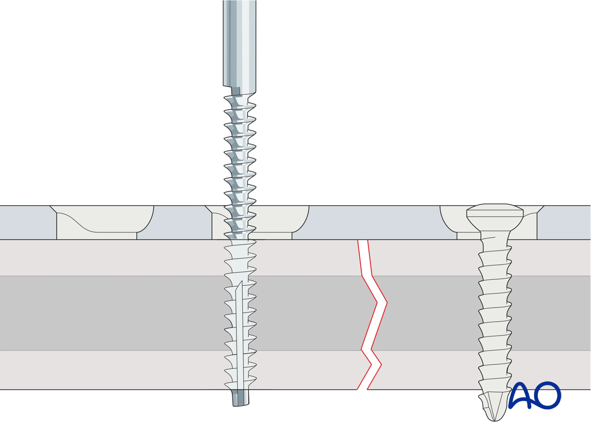 Tapping of screw holes
