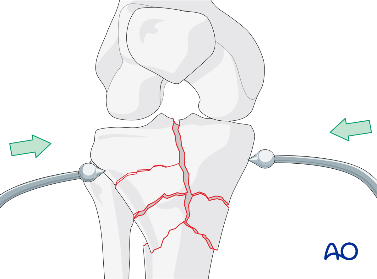 omplete simple articular fracture with fragmentary metaphyseal components: open reduction