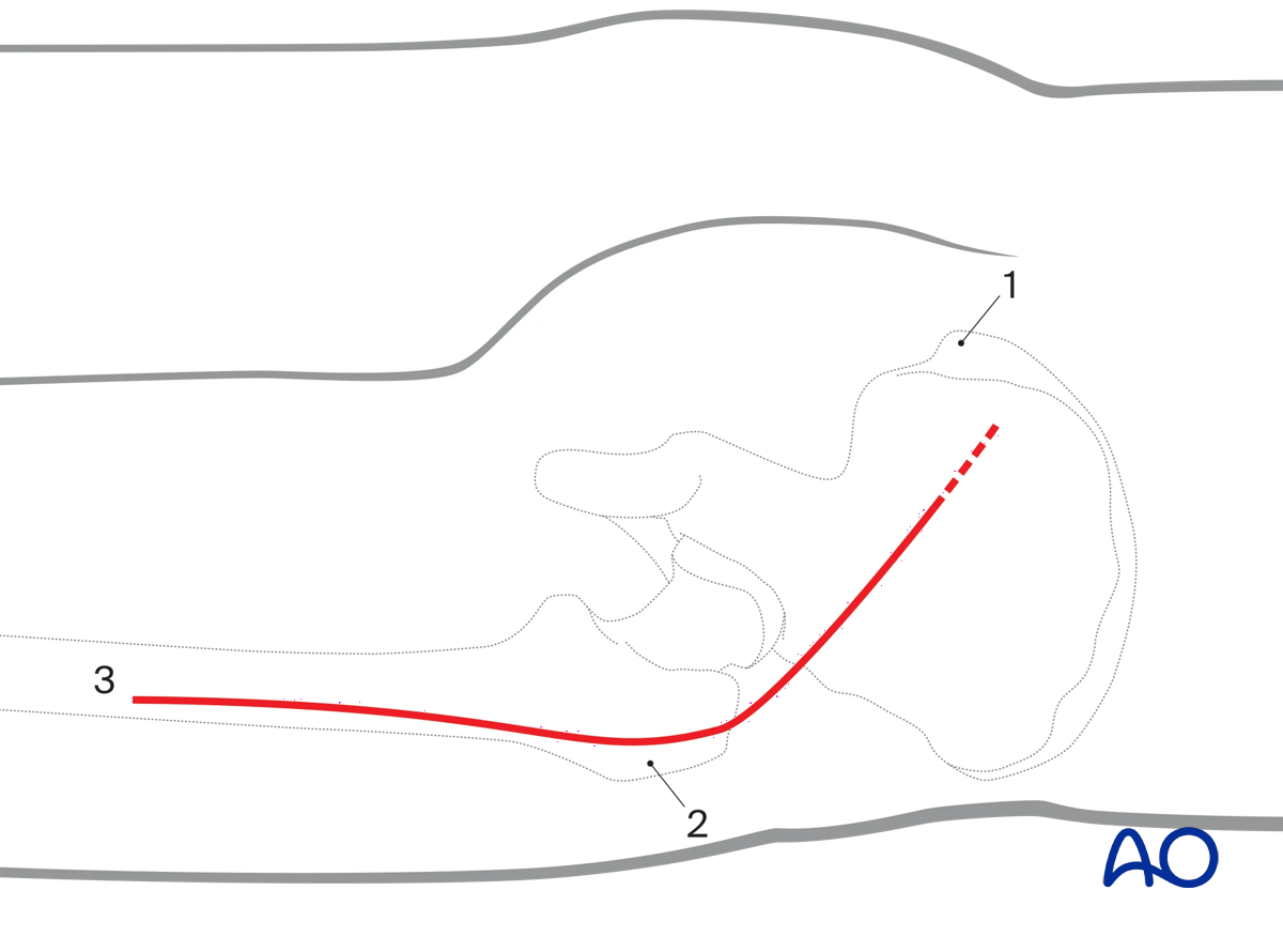 For the Kocher-Langenbeck approach, outline posterior superior iliac spine, greater trochanter, femur shaft; start incision distal to iliac spine; extend over greater trochanter; curve towards femoral shaft; end at mid-thigh.