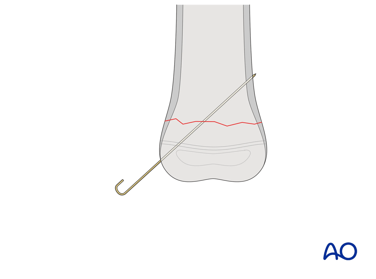 Engaging tip of K-wire in far cortex