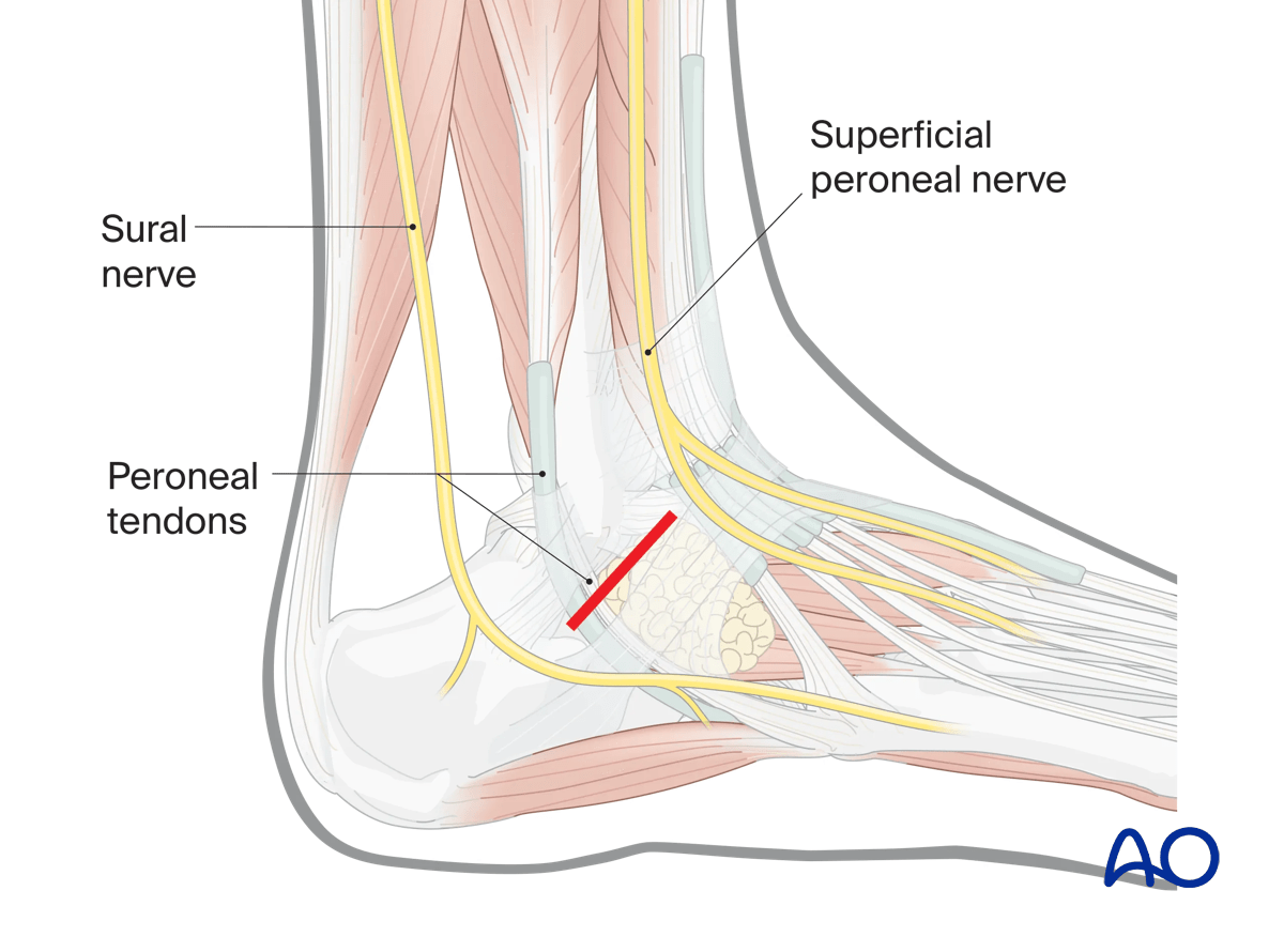 Direct lateral talus approach transverse incision; bounded by sural nerve posteriorly and superficial peroneal nerve anteriorly