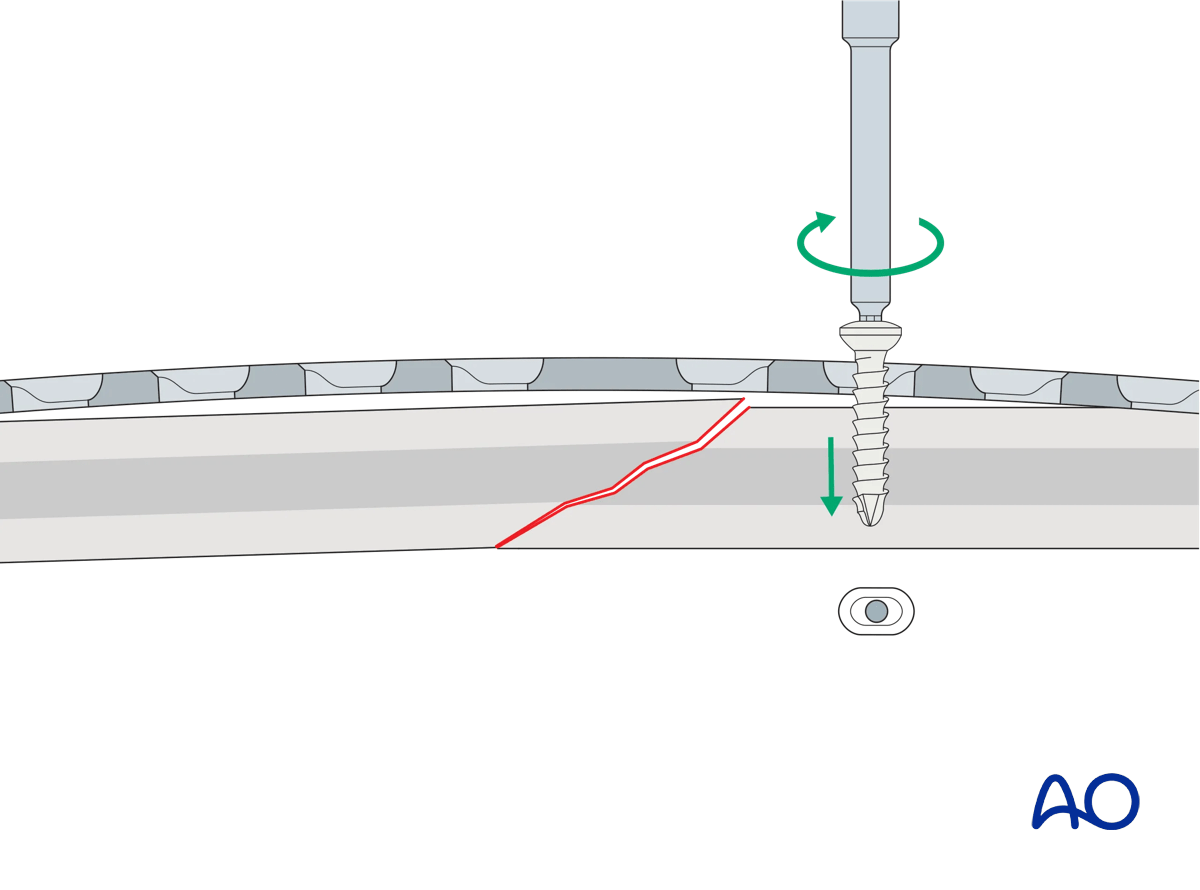 Illustration showing plate placement and neutral mode screw insertion to create an axilla in oblique fractures.