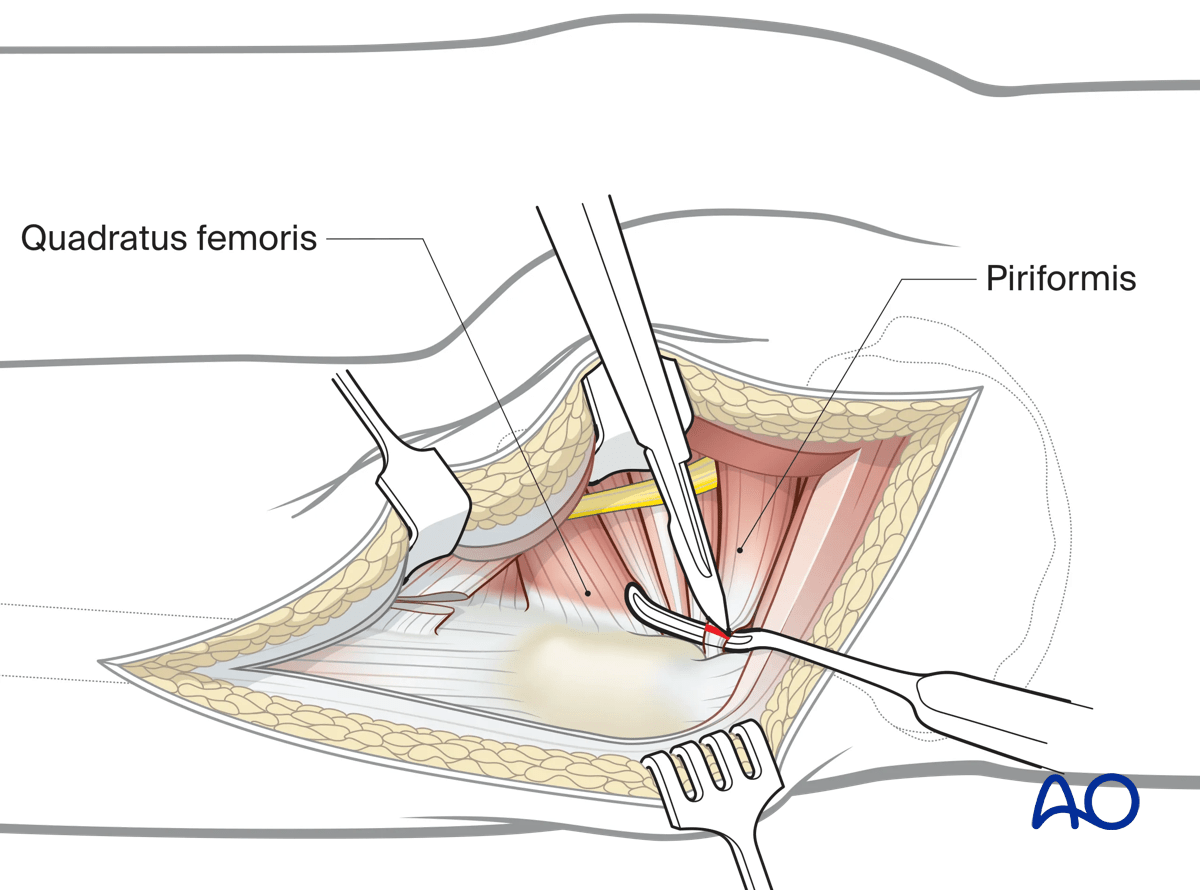 Illustration of Kocher-Langenbeck approach: detaching external rotators and isolating piriformis tendon.