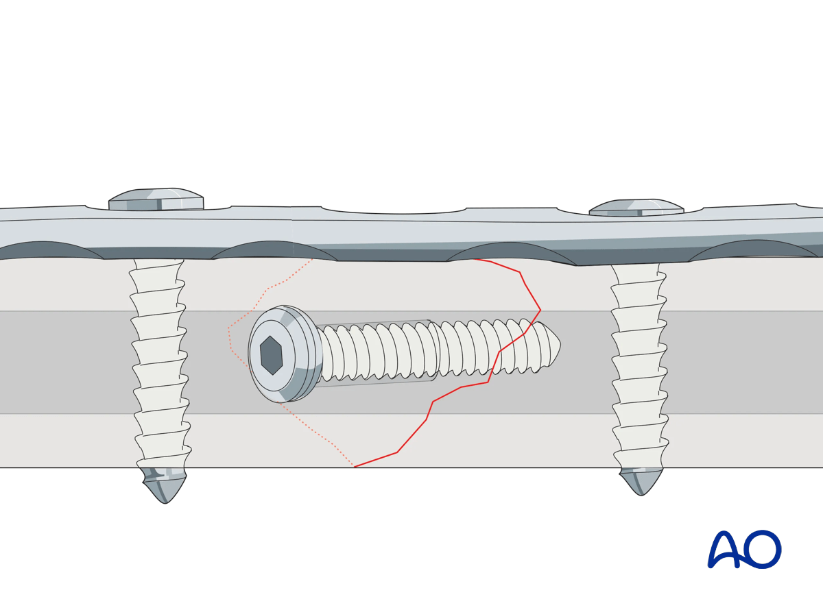 Lag screw with neutralization device