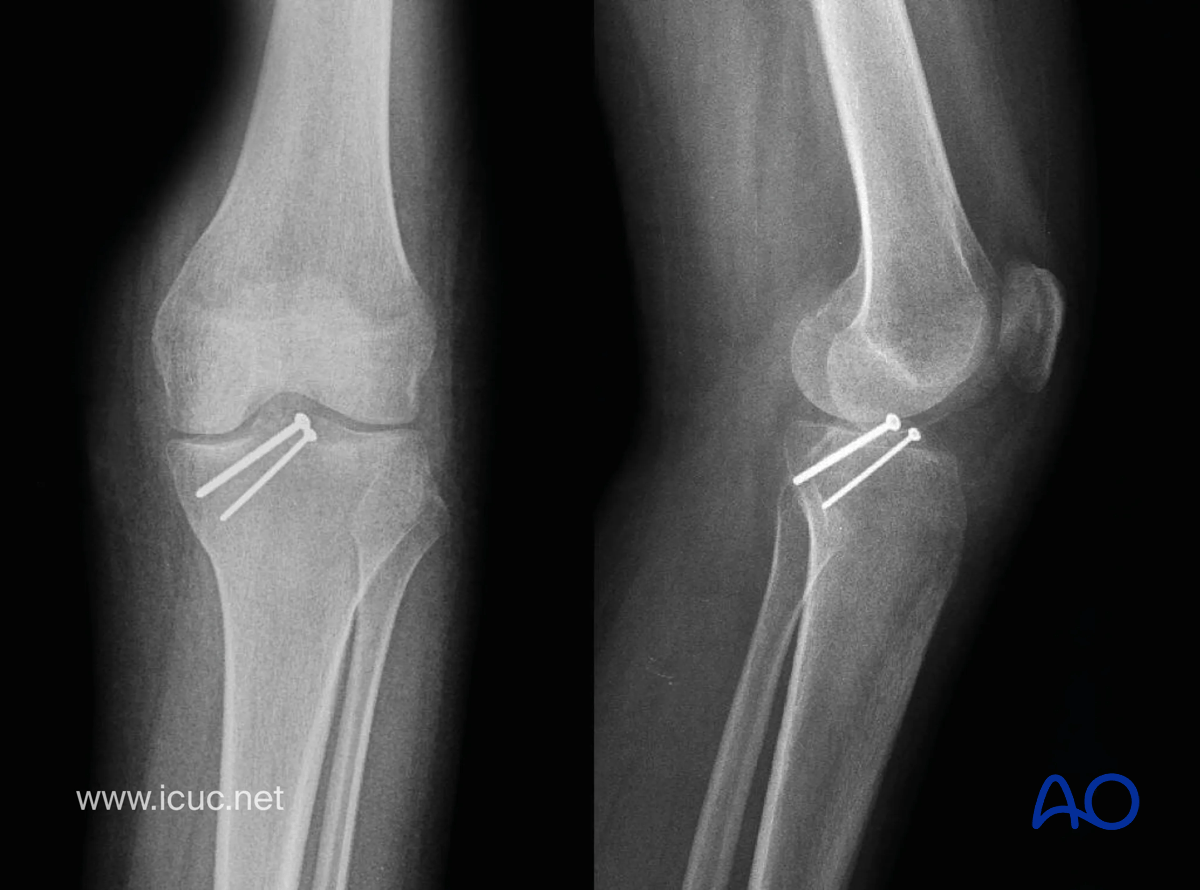 Avulsion of tibial spine – four-week X-ray showing reduction of the spine