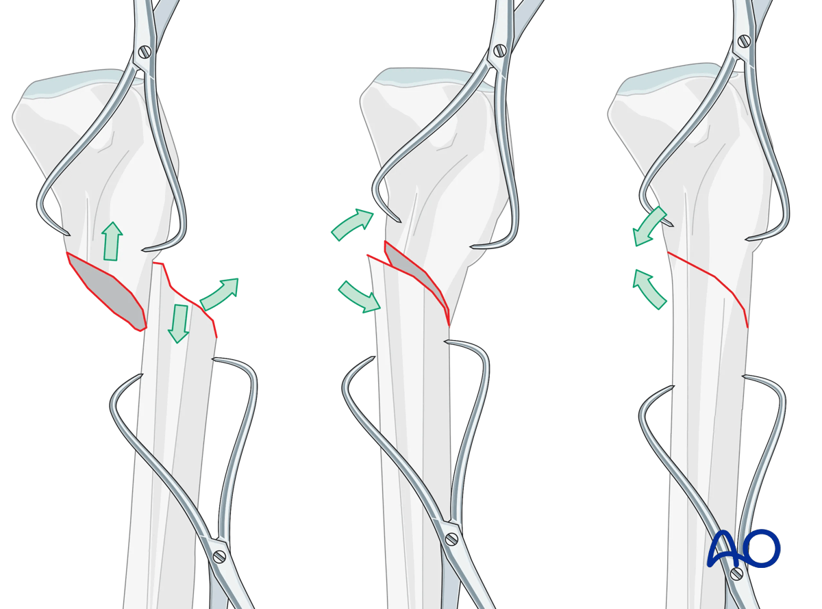 Suprapatellar intramedullary nailing, reduction of transverse fractures