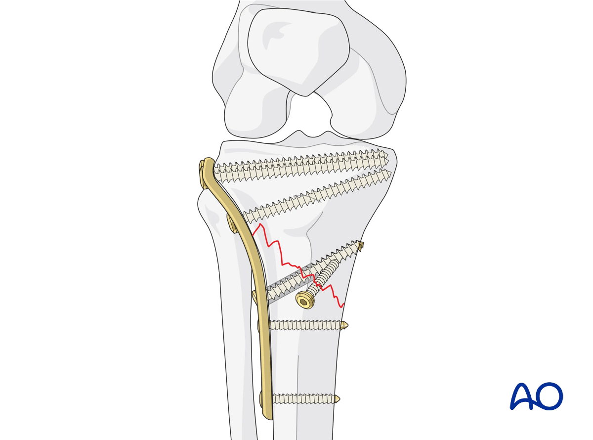 ORIF - Conventional plating, anatomical reduction