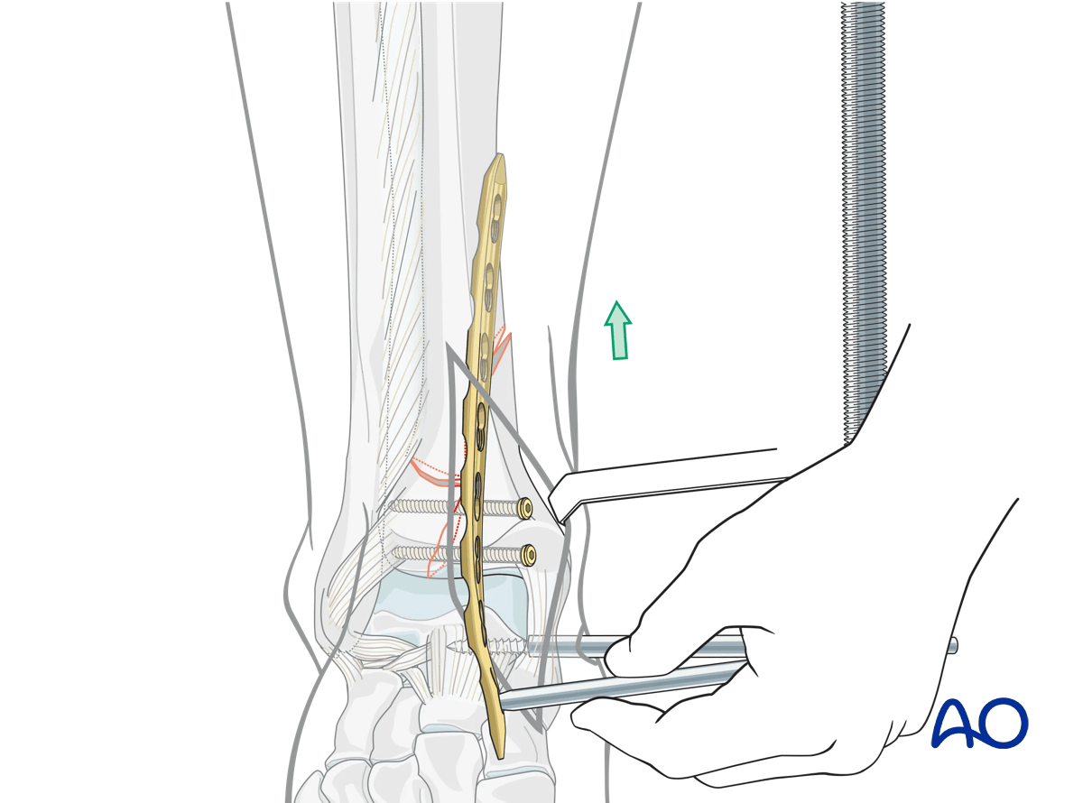 ORIF with plate and screws for stabilization of complete simple articular, simple metaphyseal fracture. Plate insertion