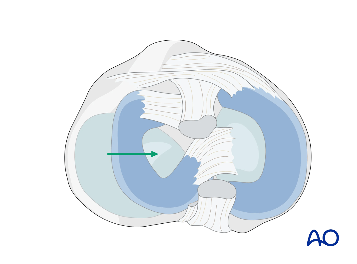 Extended anterolateral approach to the proximal tibia