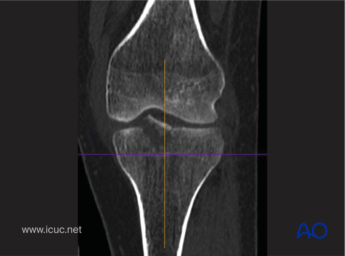CT scan in coronal image showing displacement of tibial spine