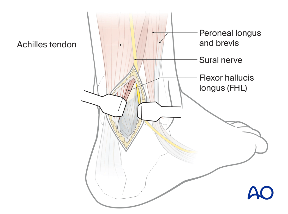 MIO posterior approach: deepen incision lateral to Achilles paratenon to calcaneum.