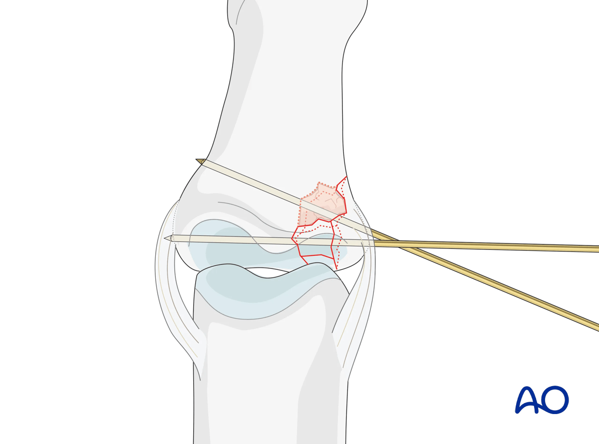 Joint reconstruction of lateral plateau fracture in middle phalangeal base, stabilize lateral fragment with K-wires.