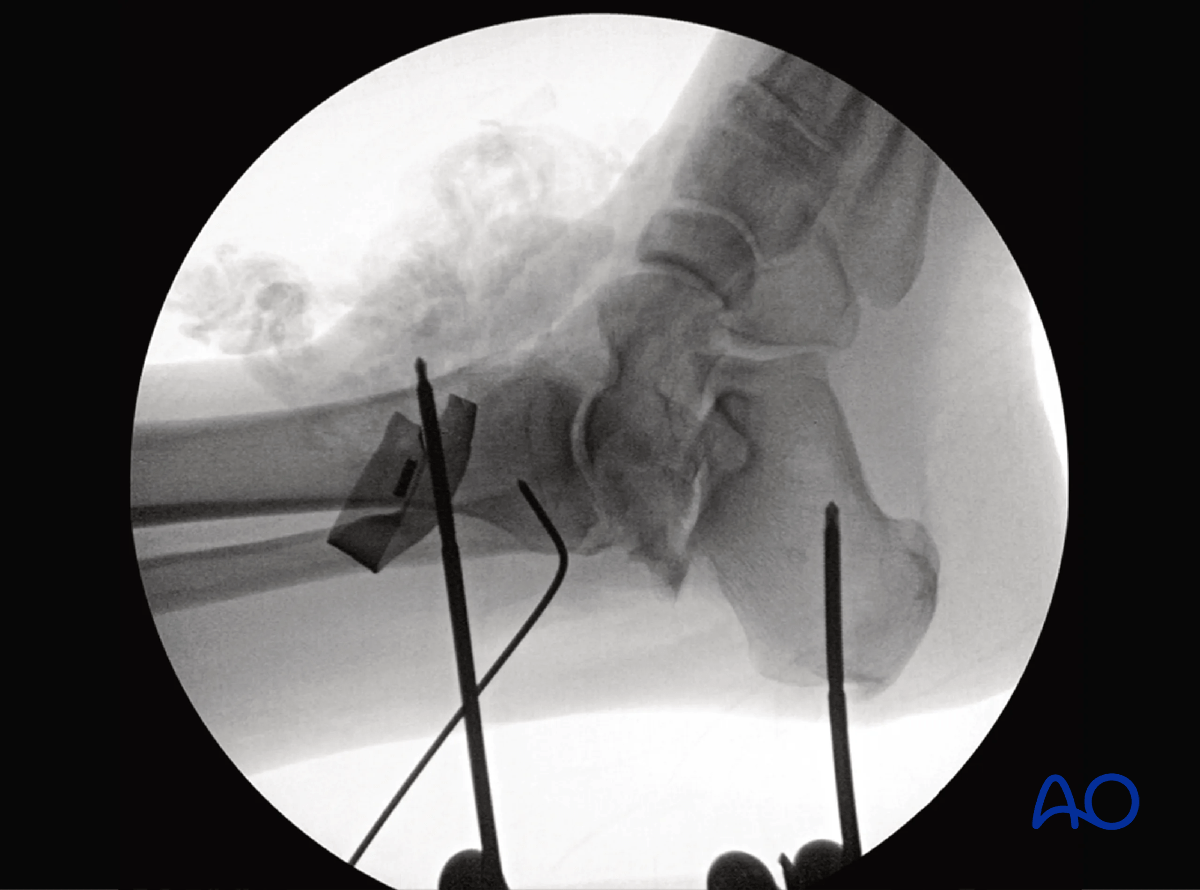 Posteromedial talus approach external fixator/distractor between distal tibia and calcaneus to aid talus exposure