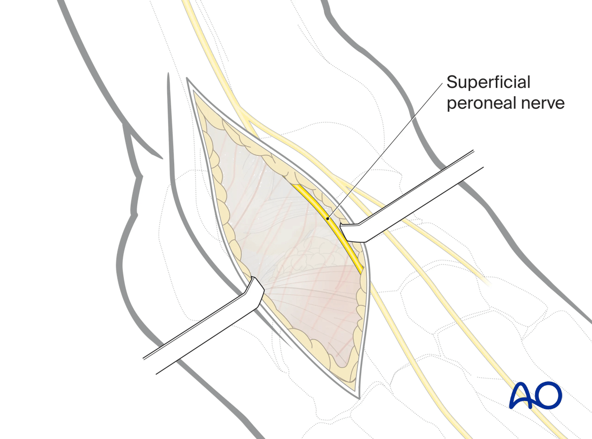 Anterolateral approach incision; superficial peroneal nerve identified and protected