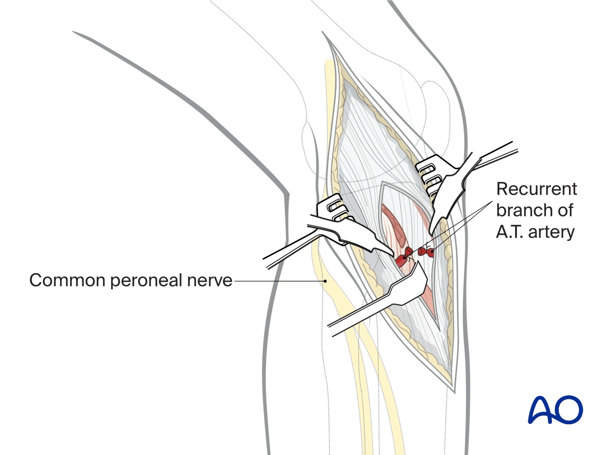 Anterolateral approach to the proximal tibia: opening the fascia