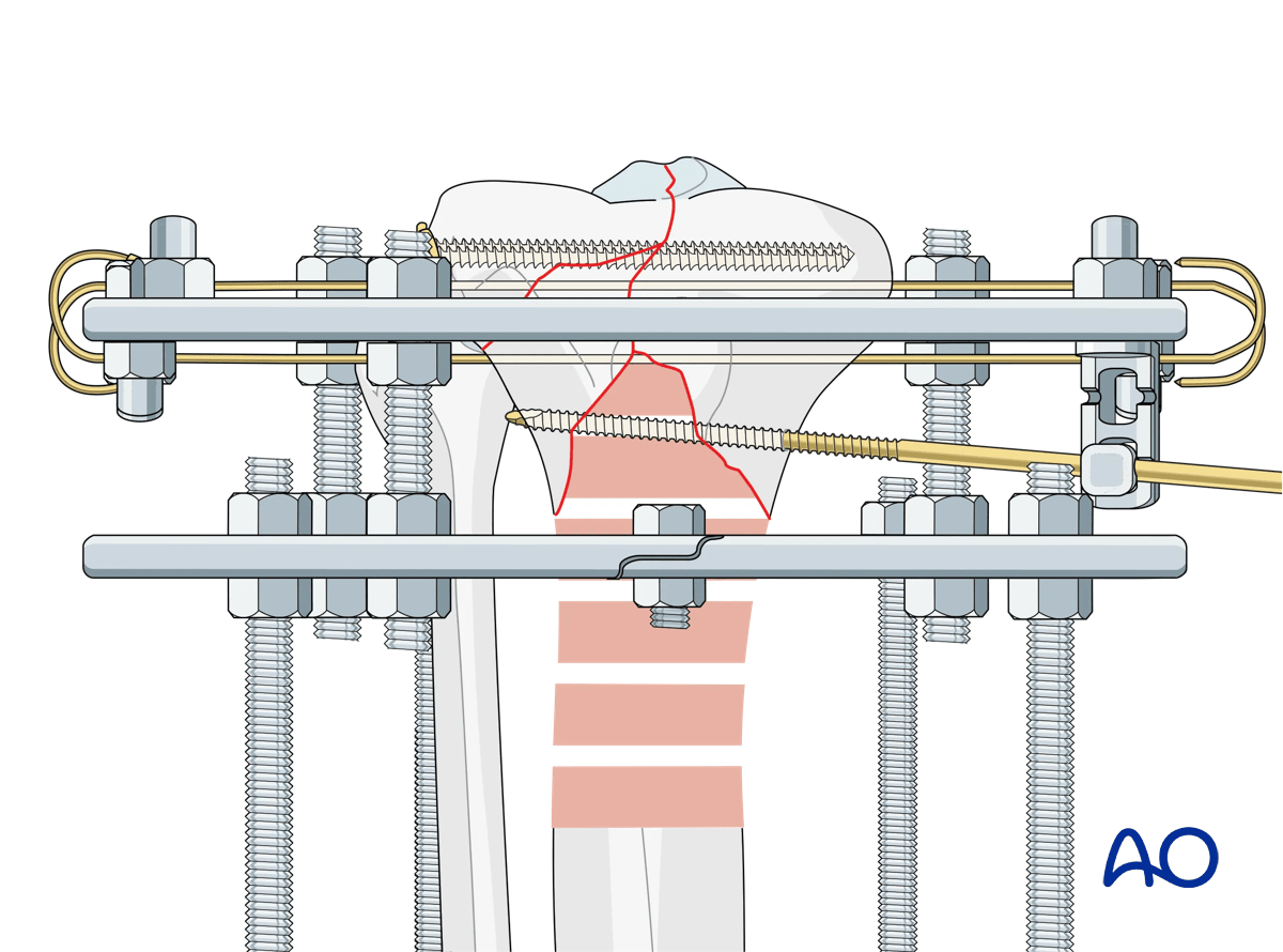 Proximal tibia fracture – ring fixation: placement of a Schanz screw into the articular bone block