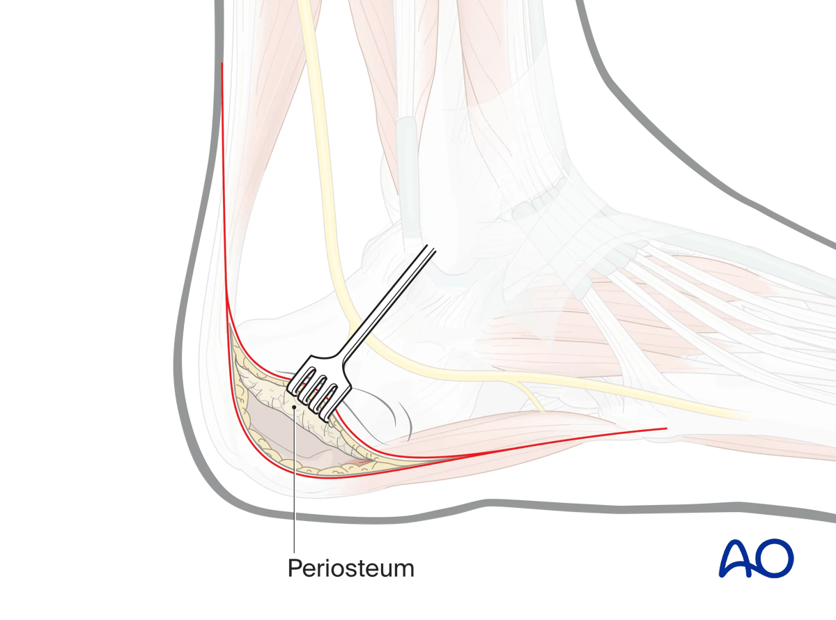Extended lateral approach to the calcaneus: deep dissection starts at incision junction onto calcaneum