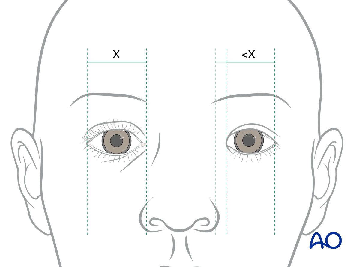 Examination of patients with NOE fractures: intercanthal distance