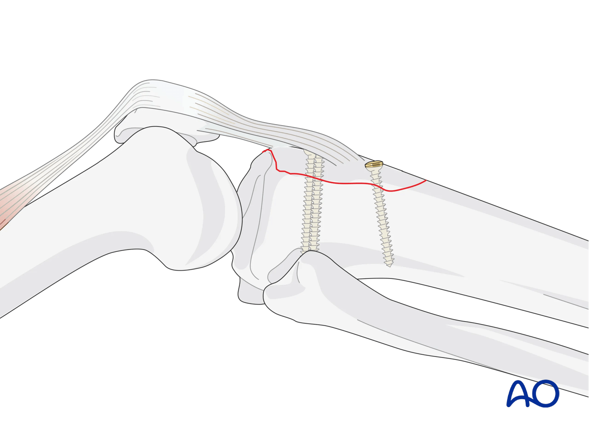 Avulsion of tibial tubercle: Lag screw application