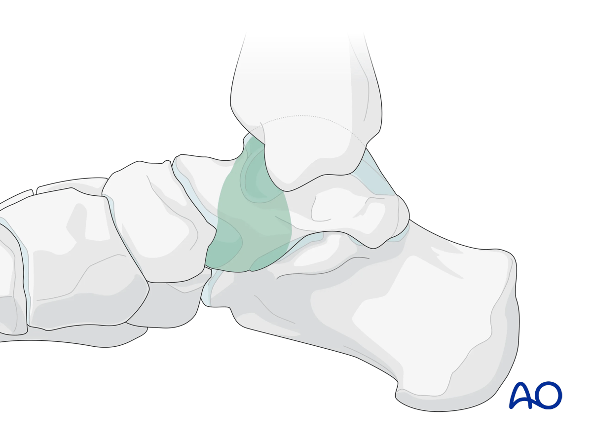 Talus regions visible through the anteromedial surgical approach