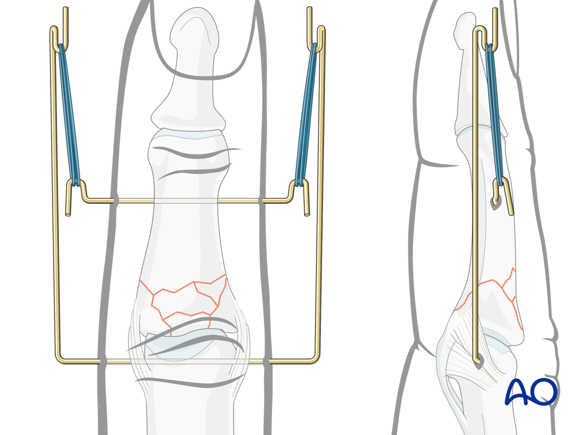 Dynamic external fixation: This setup allows for distraction using dental rubber bands.