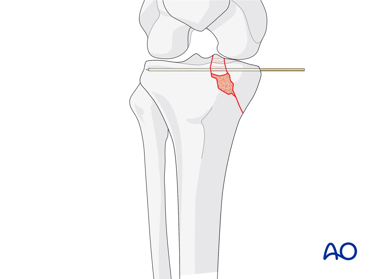 ORIF - Conventional plating, reduction of the medial articular surface