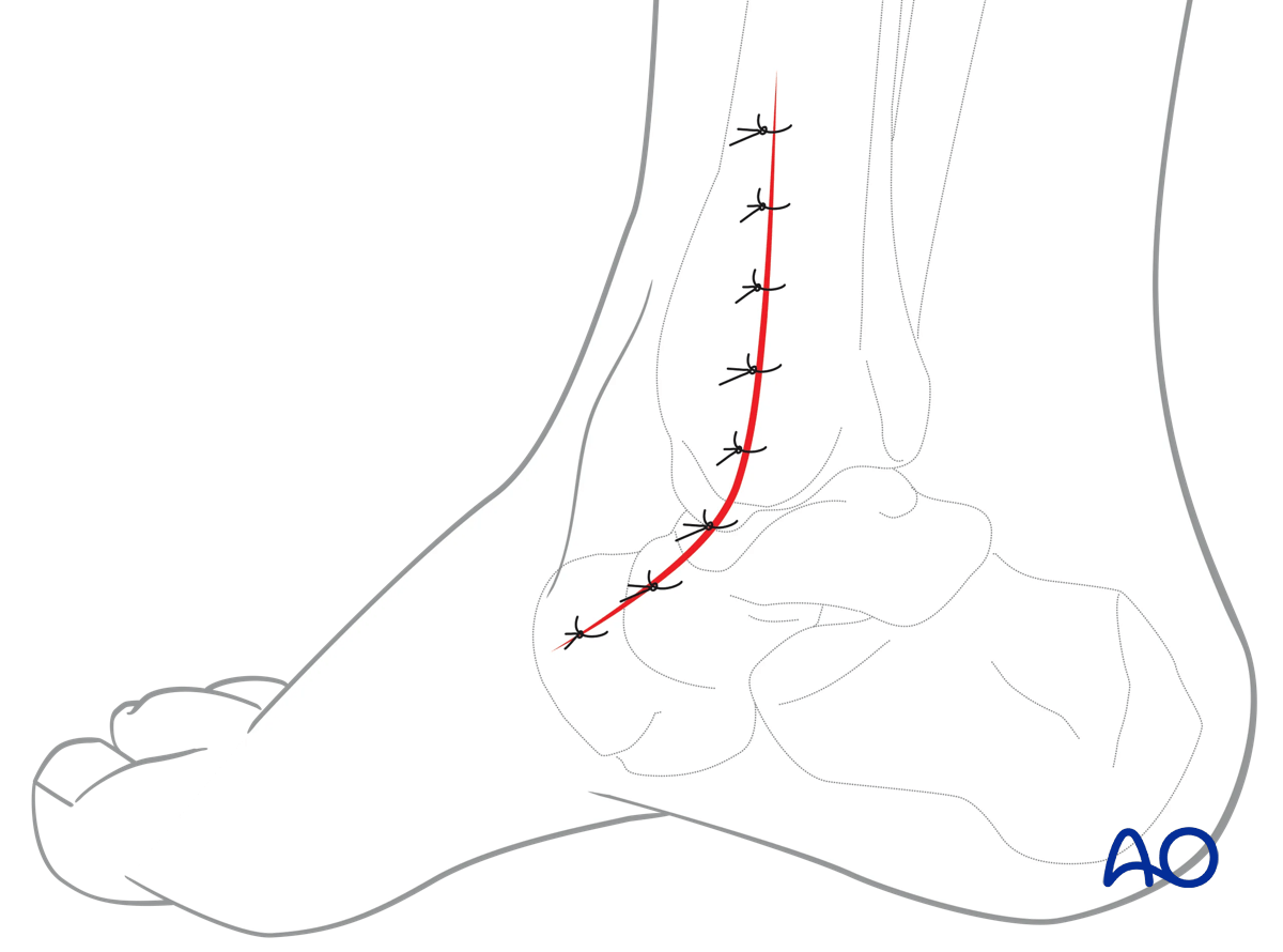 Medial malleolar osteotomy: skin incision is closed in two layers.