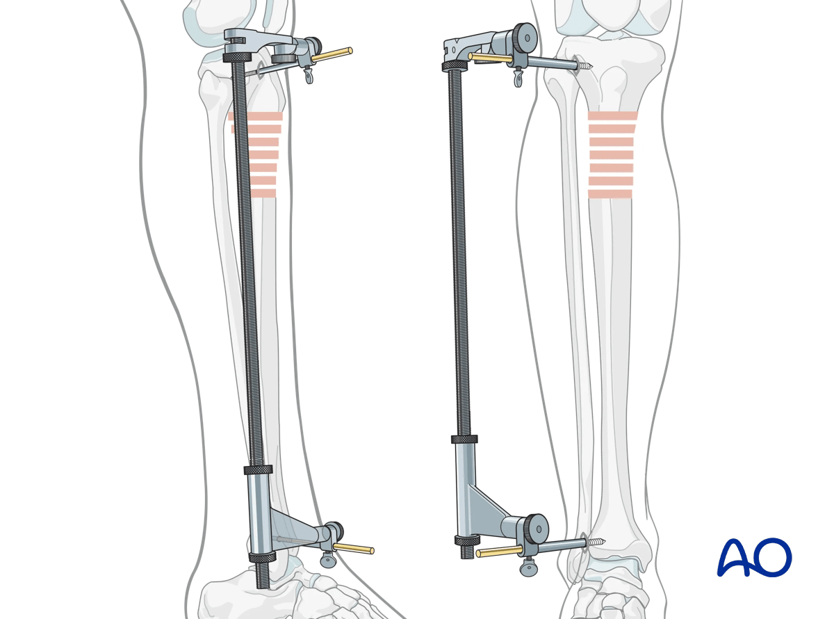 Suprapatellar intramedullary nailing, using a distractor