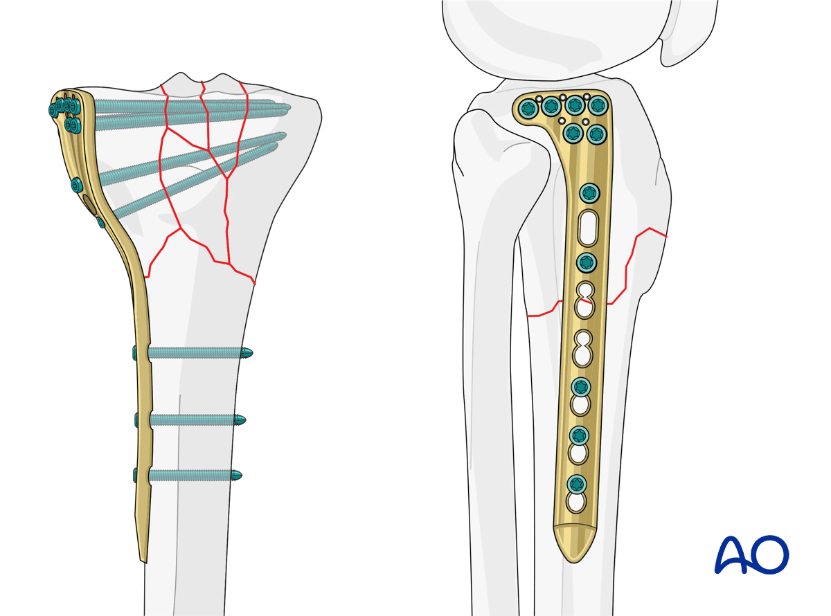 Proximal tibia: complete articular fracture - Angular stable plating
