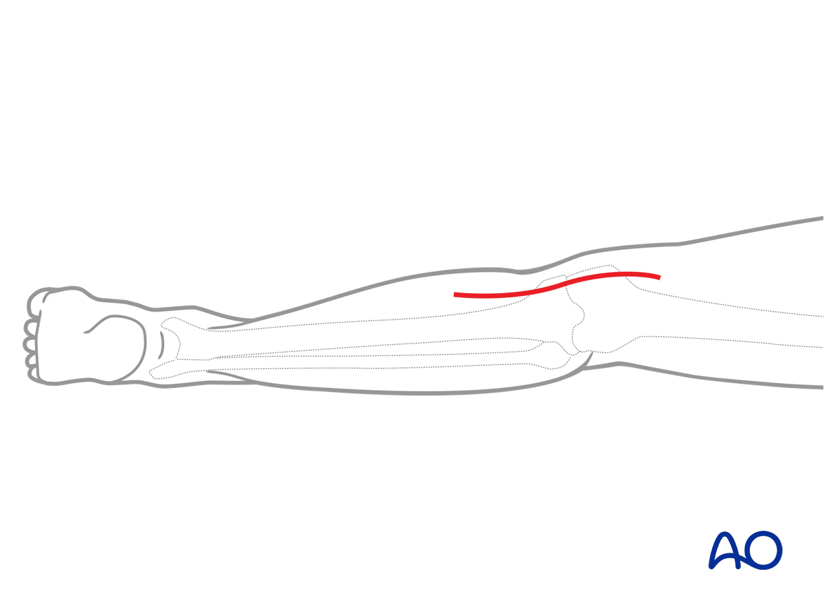 Prone posteromedial approach to the proximal tibia, skin incision