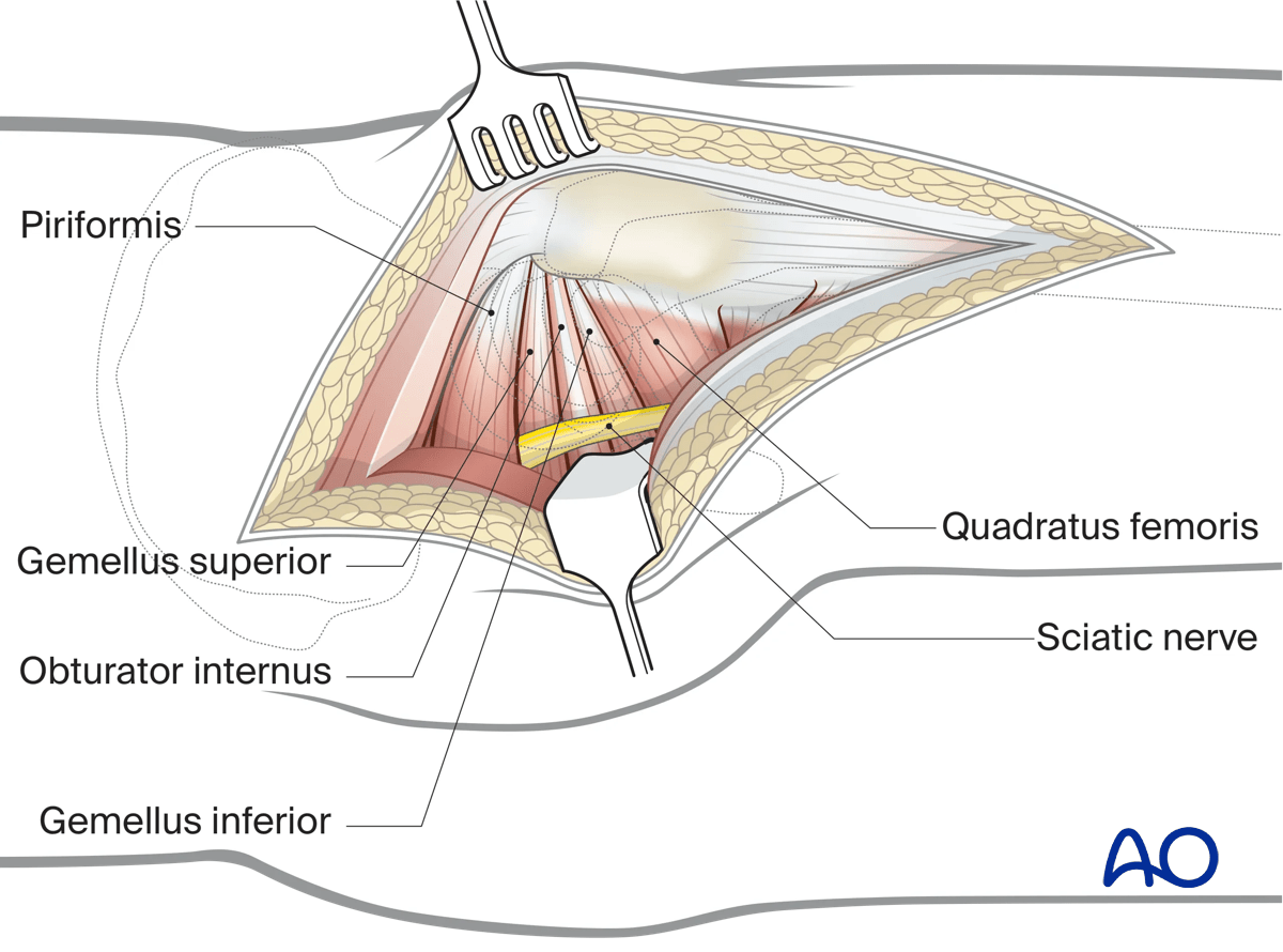 Deep dissection in a Kocher-Langenbeck approach to the hip