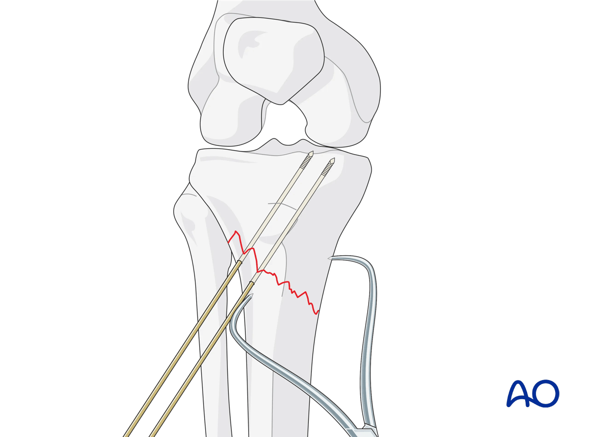 ORIF - Conventional plating, secure reduction